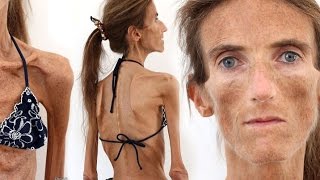 World's Skinniest Woman (Update), Valeria Levitin, Anorexia, Diet, Eating Disorders