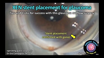 CataractCoach™ 2263: XEN stent placement for glaucoma