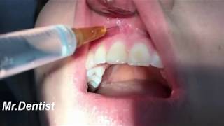 Dental Anesthesia Injection !