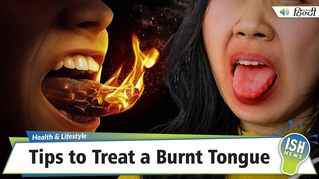 How Do You Fix A Burnt Tongue Tips to Treat a Burnt Tongue | ISH News - YouTube