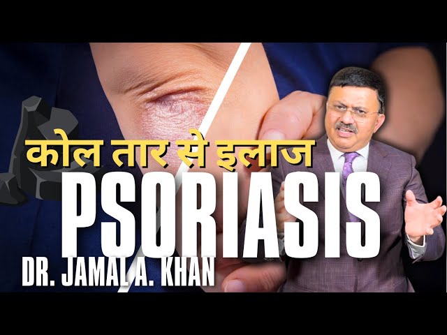 Psoriasis: Causes, Triggers and Treatments | Dr Jamal A Khan class=