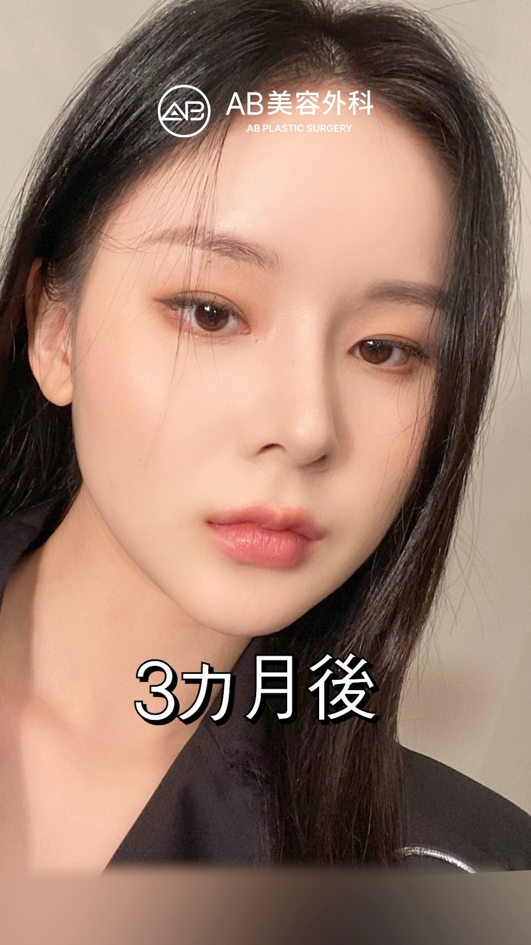 韓国で受けたナチュラル鼻整形 | AB美容整形