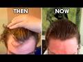 I Regrew My Hair Without a Transplant Using Only One Drug