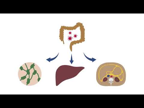 Video: O tomografie cu substanță de contrast va arăta cancer de colon?