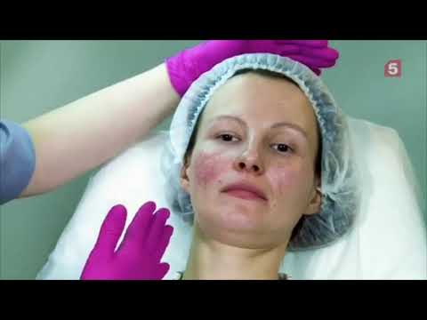 МЫ НА КАНАЛЕ 5_tv. ЧТО ТАКОЕ РОЗАЦЕА И КАК ЕЕ ЛЕЧИТЬ. #ШКОЛАРОЗАЦЕА 23.01.2020г.