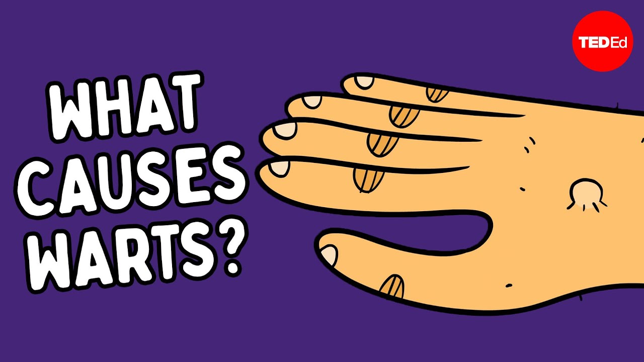 What are warts — and how do you get rid of them? - Cella Wright