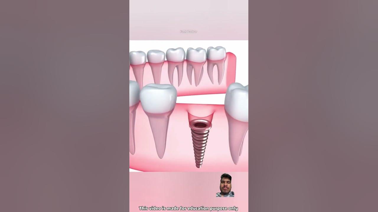 how-is-sinus-lift-surgery-done-youtube