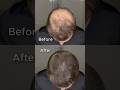 Miraj : The anti-baldness cream