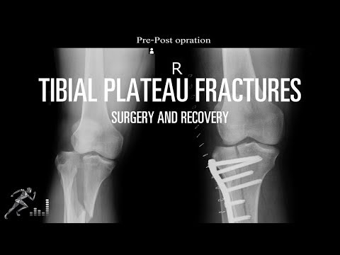 Video: Eenvoudige manieren om een tibiale plateaufractuur te diagnosticeren en te behandelen