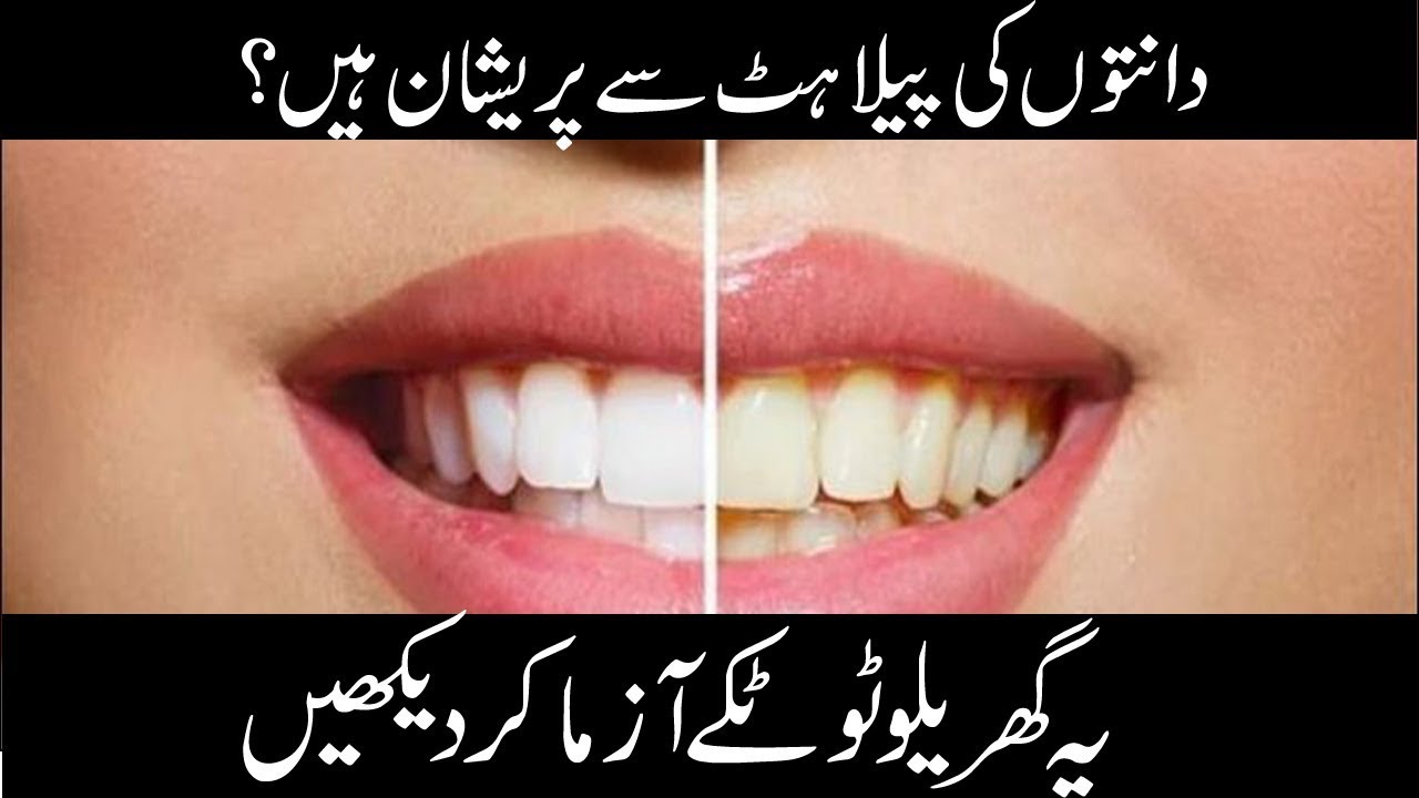 Worried about tooth decay | teeth whitening at home in ...