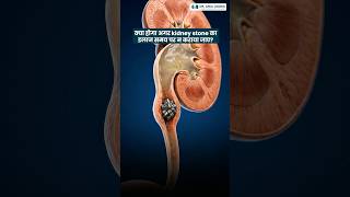 Can a Kidney Stone Damage Your Kidney? | क्या किडनी स्टोन से किडनी खराब हो सकती है? #kidneystone