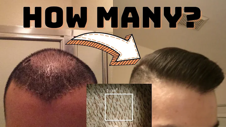 How Many Grafts Do You Need for Density?