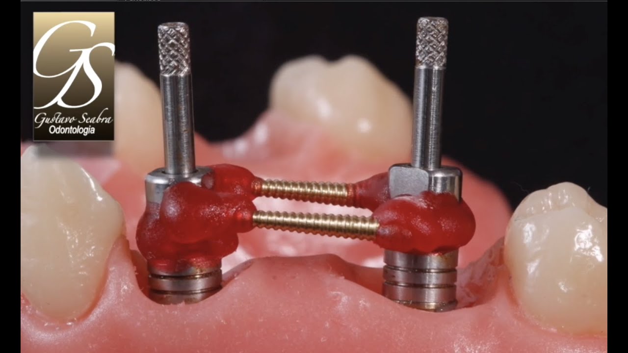 Moldagem do MiniPilar Cônico - Moldeira Aberta