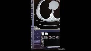 How to Change Patient Information and Use of Raw Data for volume formation 