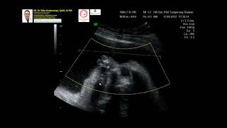 Phocomelia - Amelia Dr Wiku Andonotopo