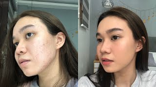 How To Cover Acne Marks/Pimples with No Foundation | Andy Buela (Philippines)