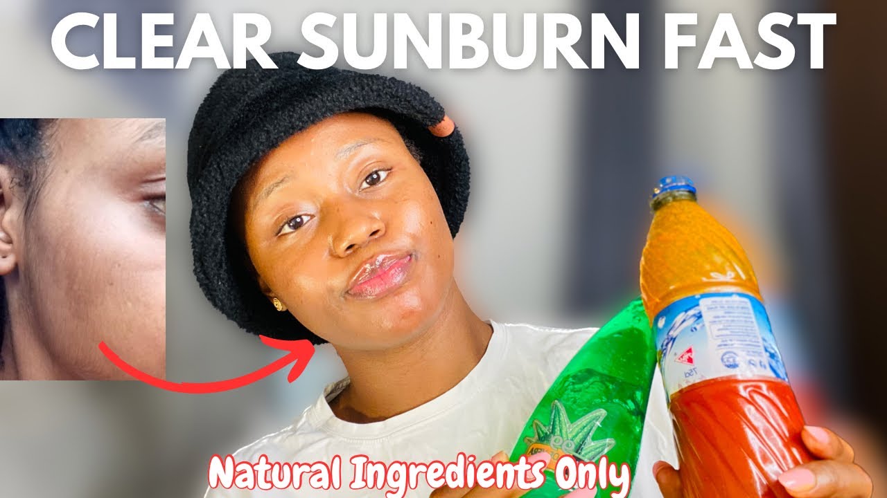 CLEAR SUNBURN FAST WITH ONLY NATURAL INGREDIENTS ‼️ - YouTube