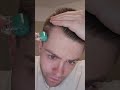How I Use Minoxidil And The Derma Roller For Hair RESTORATION How I Use Minoxidil And The Derma Roller For Hair RESTORATION