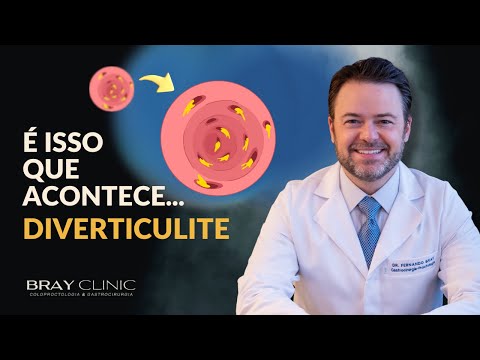 Vídeo: Dieta para Aliviar a Crise de Diverticulite: O que PODE e NÃO PODE