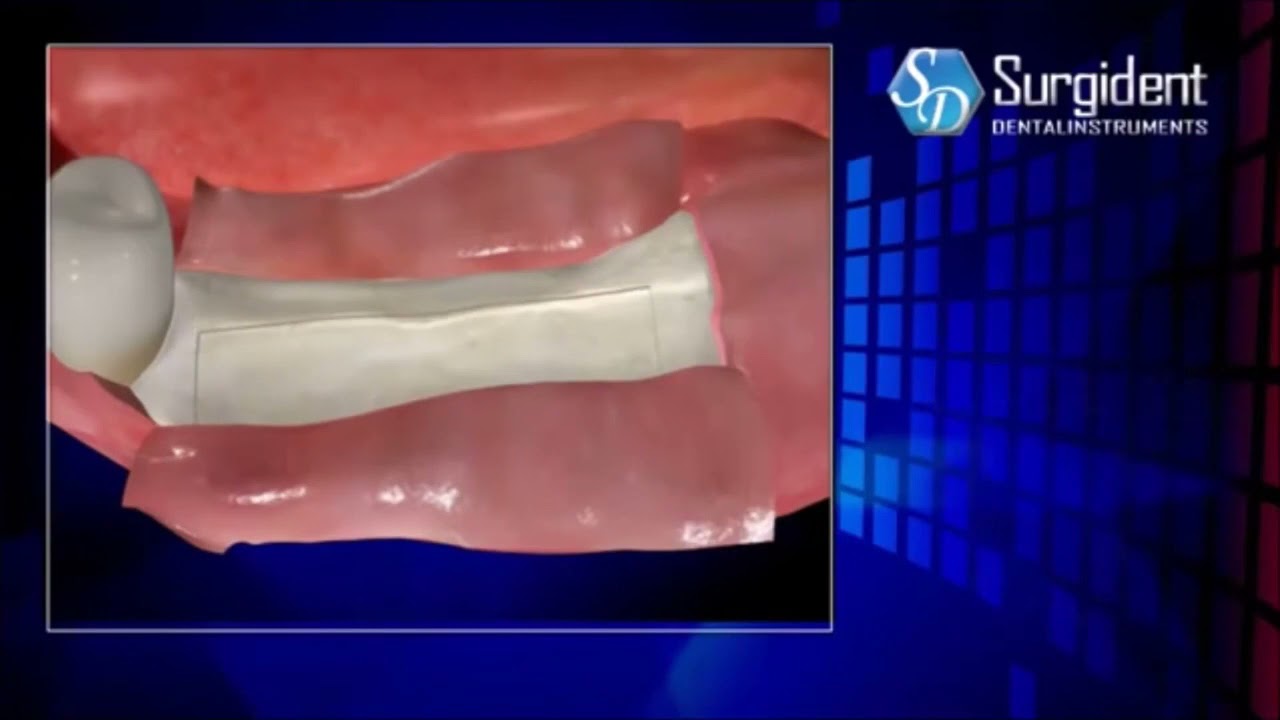 Bone Spreading Kit for Ridge Splits