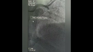 Thông tắc mạch vành sau đặt Stent cứu sống người bệnh nhồi máu cơ tim_BV Hữu nghị Việt Nam - CuBa ĐH