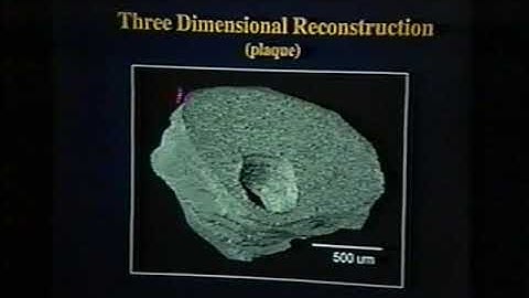 Early OCT Talk (Duke 1998): Lesions Learned. #OCT#Brezinski#Mark#Fujimoto#Cardiology#Harvard#plaque