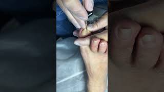 Ingrown toenail removal with Pedicure Knife, Cut it easily Ep567