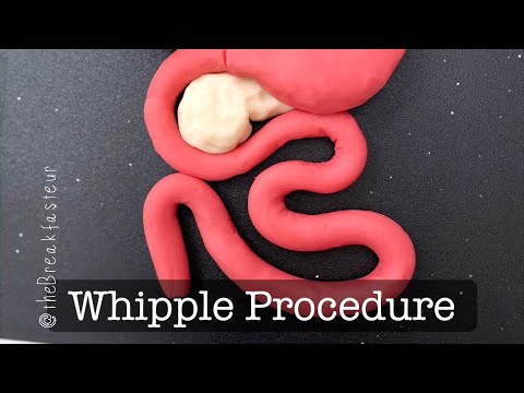 Playdough Surgery ?? - Pylorus-Preserving Pancreaticoduodenectomy AKA Whipple Procedure - Part I