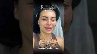 **Smile Line Treatment at Cici Beauty – Natural Nasolabial Fold Softening in Hanoi** Smile lines ar