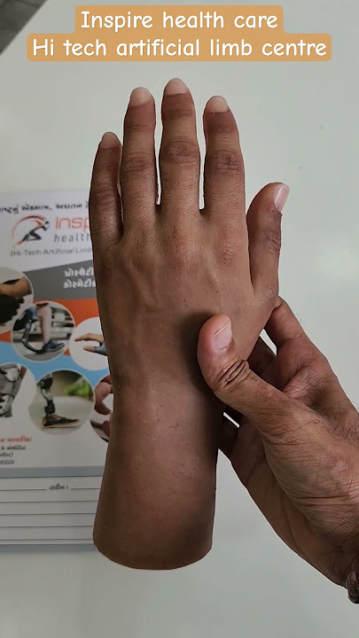 🔸Best quality Silicone Artificial hand 🖐️ at Inspire health care, Hi tech artificial limb centre