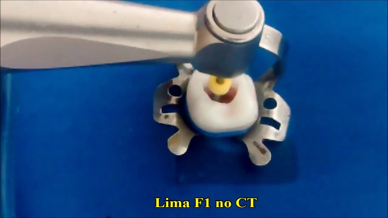 Preparo do Canal Radicular - Sistema Protaper Universal