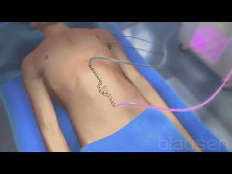 HIPEC Procedure - Hyperthermic Intraperitoneal Chemotherapy