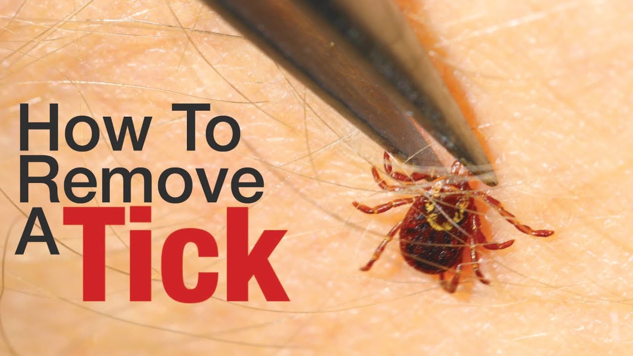 How To Remove A Tick