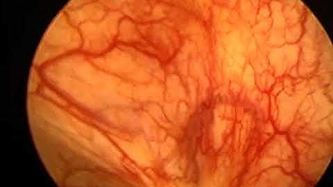Endoscopic view of interstitial cystitis bladder during low pressure cystoscopy