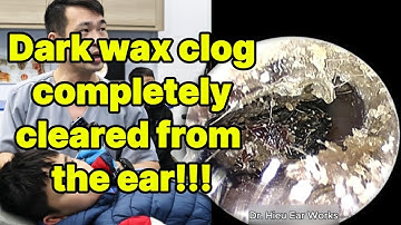 Dark wax clog completely cleared from the ear | ear cleaning | ASMR earwax | soothing |relax|