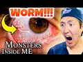 Plastic Surgeon Reacts to MONSTERS INSIDE ME! WORM in EYEBALL!