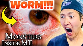 Plastic Surgeon Reacts to MONSTERS INSIDE ME! WORM in EYEBALL!