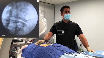 Radiofrequency Ablation Procedure