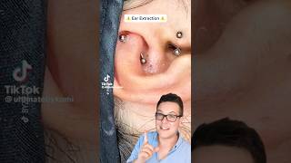 BLACKHEADS IN EAR - Blackhead Removal From Ear #shorts