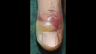 Drainage of Paronychia.
