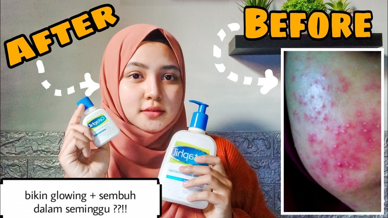 REVIEW CETAPHIL GENTLE SKIN CLEANSER DI KULIT SENSITIF BERJERAWAT Jerawat & Bruntusan sembuh 😍