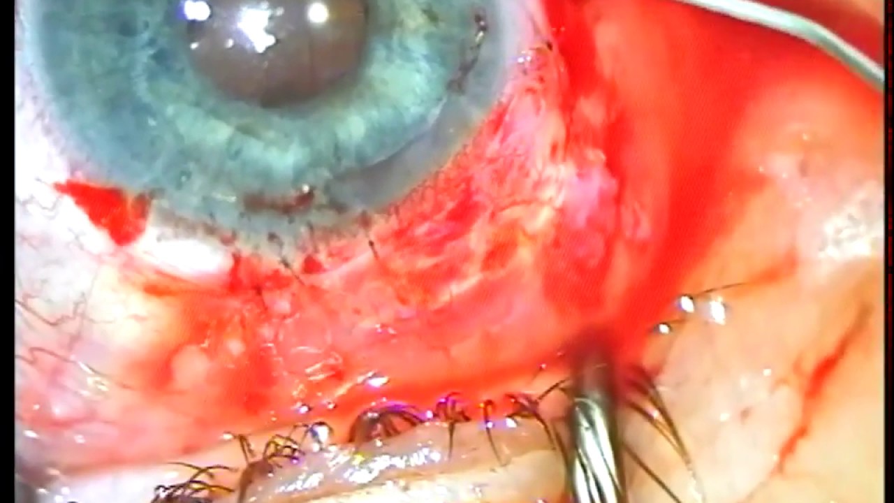 STARflo implantation surgery - Dr Łukasz Bednarski