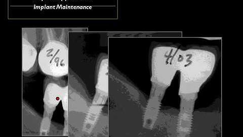 Implant Management with T Scan™: Part 1