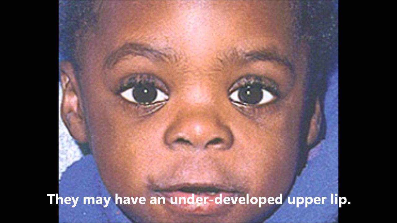 Foetal Alcohol Syndrome. - YouTube