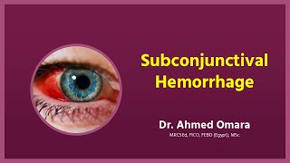 37 Wills eye manual - Subconjunctival hemorrhage (Arabic narration)