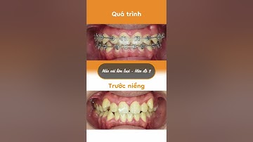 Hành trình LỘT XÁC nhờ niềng răng của Thiên Bảo
