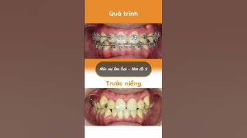 Hành trình LỘT XÁC nhờ niềng răng của Thiên Bảo