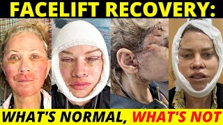 Facelift recovery day by day: What