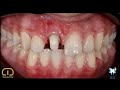 Clinical Case Management Of Internal Discoloration Dr Mostafa Taha Clinical Case Management Of Internal Discoloration Dr Mostafa Taha