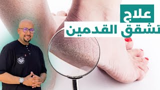 علاج تشقق القدمين | العناية بالقدمين | الدكتور عماد ميزاب Docteur Imad Mizab